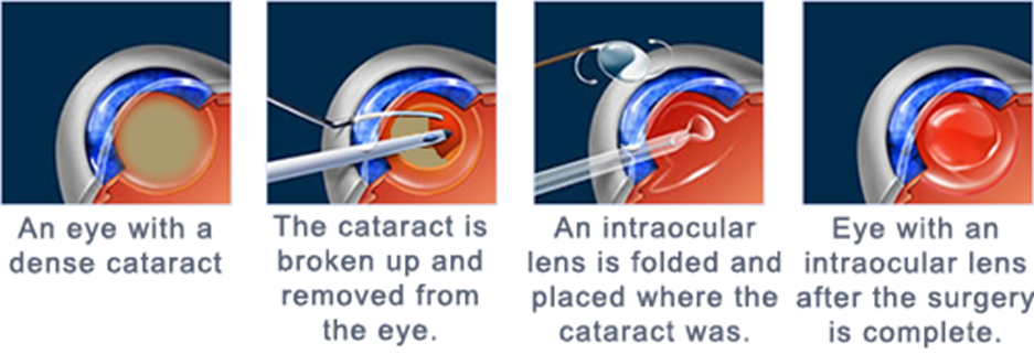 Cataracts San Francisco | Cataract Surgery San Francisco | Goodman Eye