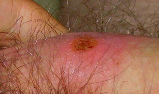 NATURAL PIMPLE TREATMENTS " = -: pimple on penis shaft remedies