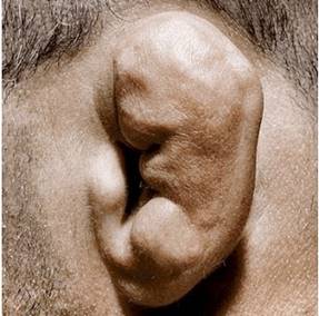 Image result for cauliflower ear