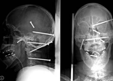 Image result for 10 penny nail in forehead xray