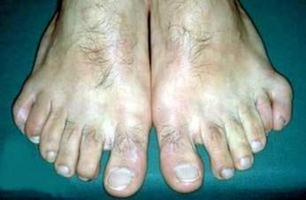 Image result for six fingers and toes dominant trait