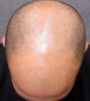 Image result for no hair