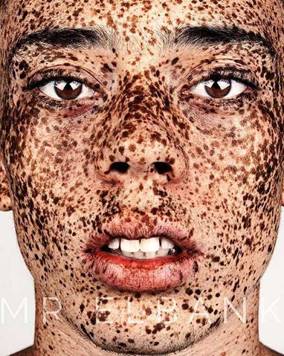 Image result for massive freckle face