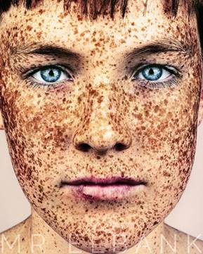 Image result for freckle face